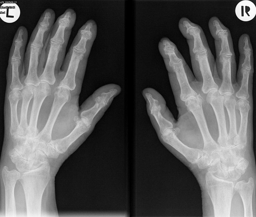 Rheuma beschreibt den Sammelbegriff für viele unterschiedliche Erkrankungen: Experten sprechen von über 400 verschiedenen Rheumaerkrankungen, wie Arthritis Urica, Arthrose, chronische Polyarthritis, Morbus Bechterew, Perichondritis, das Fibromyalgie-Syndrom, u.v.m. Rund zwei Millionen Österreicherinnen und Österreicher leben mit Rheuma, darunter auch 1000 Kinder unter 16 Jahren.